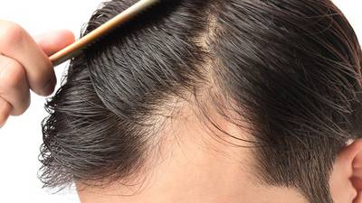 Finasteride vs. Minoxidil: Which men's hair loss treatment is best? –  Boston 25 News