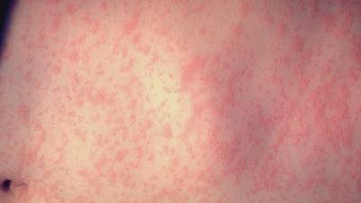 Health officials announce 1st confirmed measles case in Mass. resident since 2020